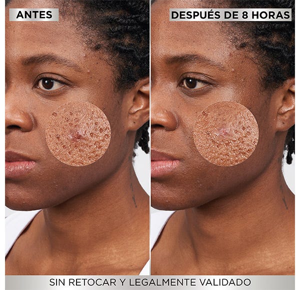 Garnier 8 Hours Pimple Patch