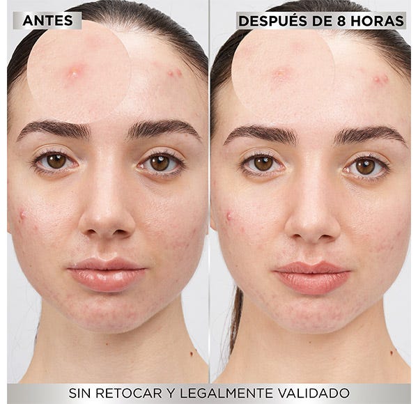 Garnier 8 Hours Pimple Patch
